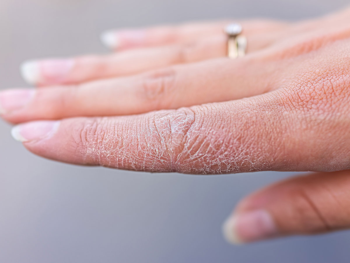 home remedies for chapped hands