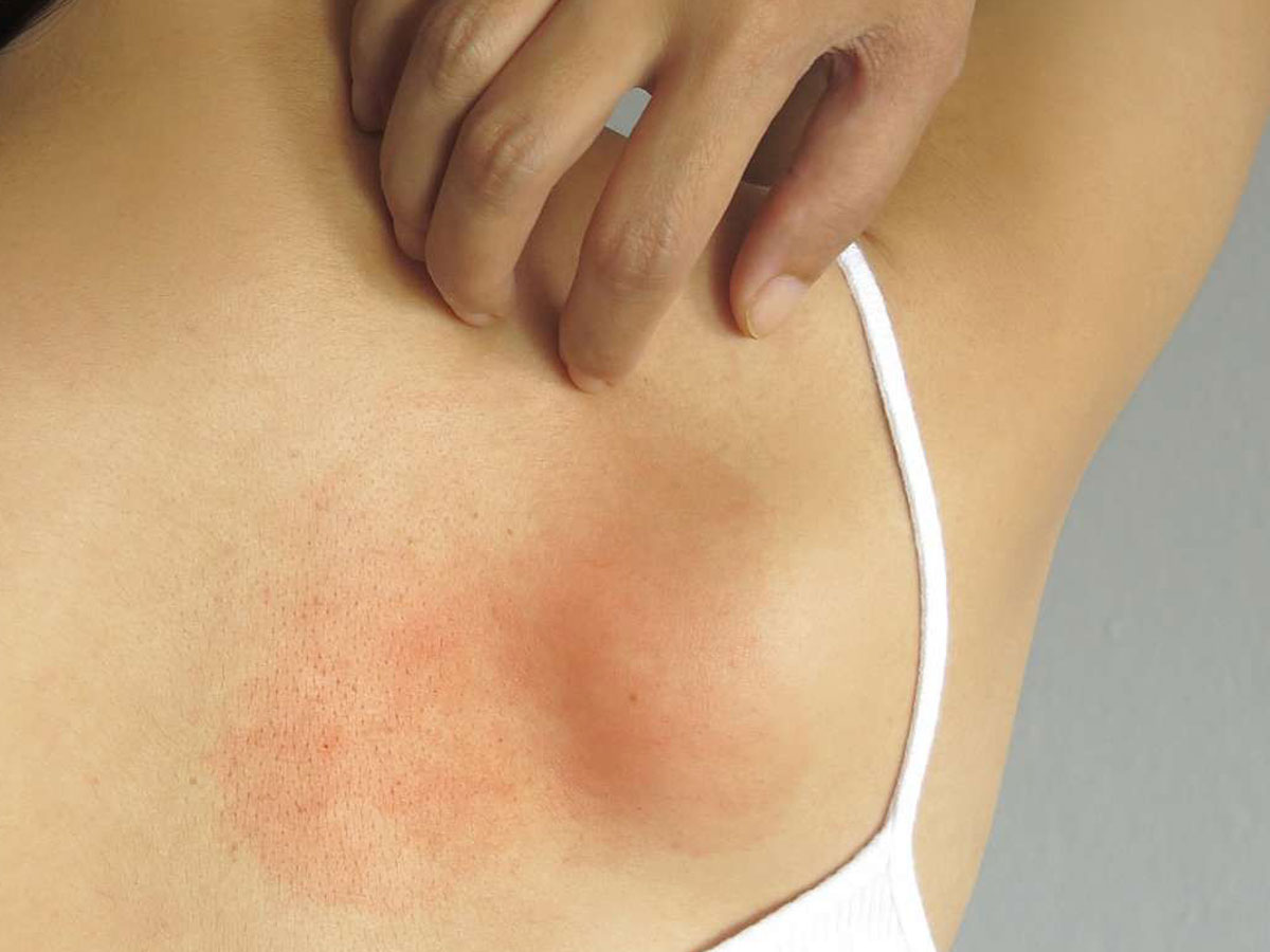 home remedies for dry skin and winter itch